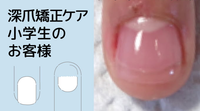 深爪矯正ケア、小学生のお客様