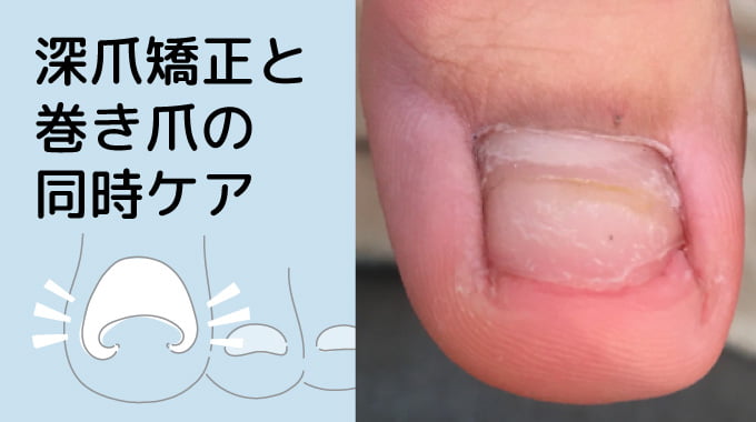 深爪矯正と巻き爪の同時ケア