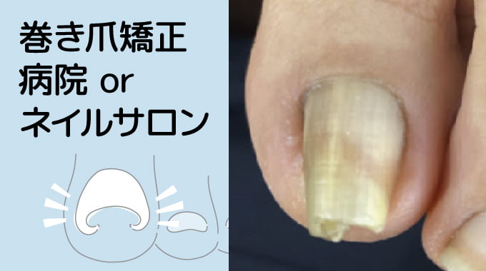 巻き爪矯正ケア、病院 or ネイルサロン
