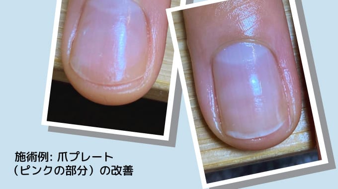 爪プレート（ピンクの部分）の改善施術
