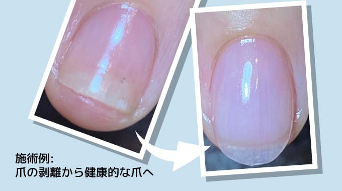 施術例：爪の剥離から健康的な爪への改善