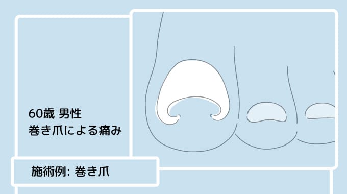 痛みなく、安心の巻き爪ケア