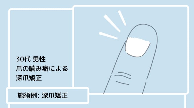 噛み癖による爪ダメージの改善